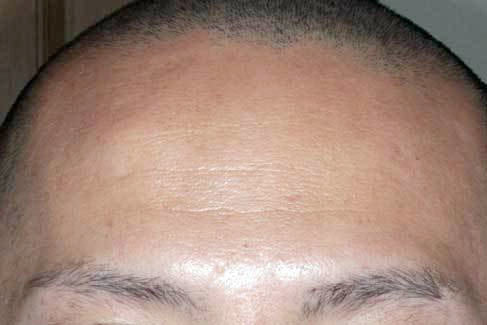 額(静止時)治療前