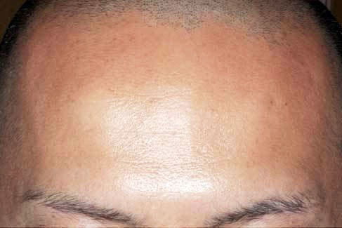 額(静止時)治療後