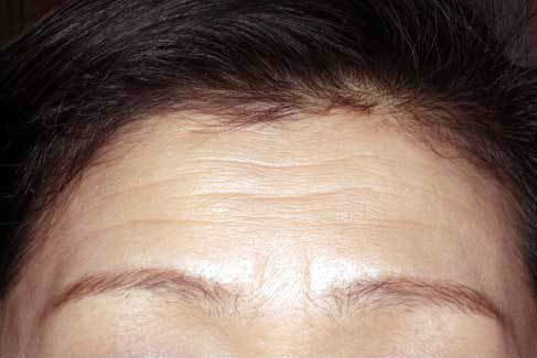 額(収縮時)治療前