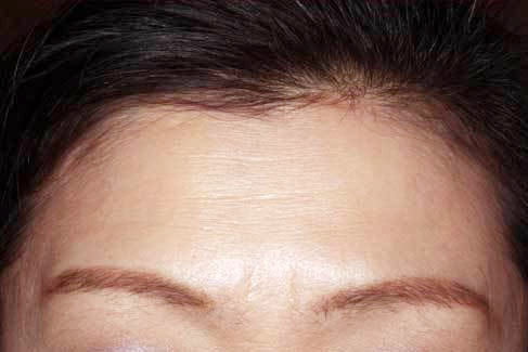 額(収縮時)治療後