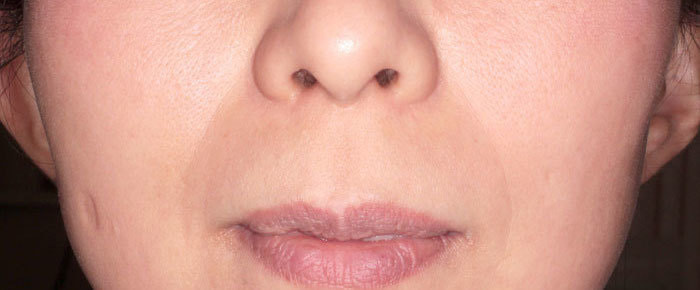 ほうれい線 治療前