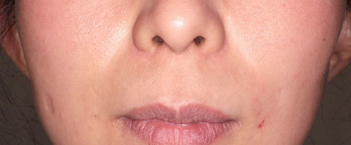 ほうれい線 治療直後