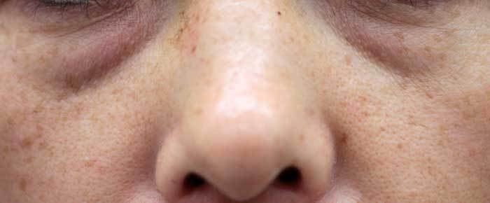 ゴルゴライン 治療前