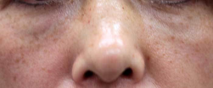 ゴルゴライン 治療2週間後