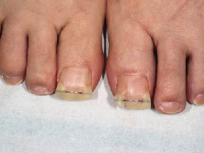 治療2週間後 治療2週間後。ちょっとしたテクニックを用いたため、2週間で根元まで矯正されています。