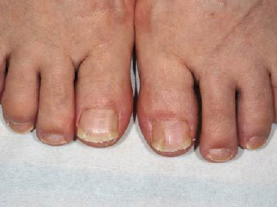 治療2週後 爪を切ってワイヤーを外しました。わずか2週間で非常に満足できる結果となりました。