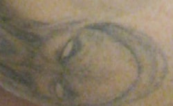 ピコレーザー治療前