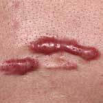 ケロイド イメージ