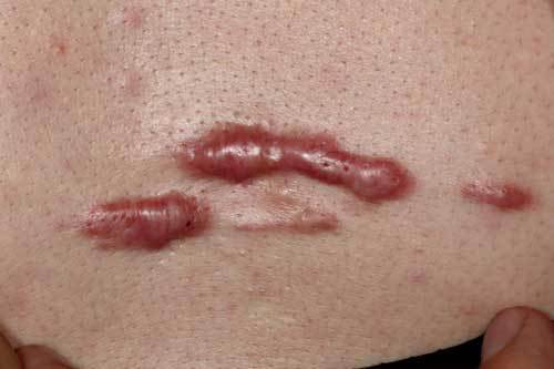 ケロイド 治療前