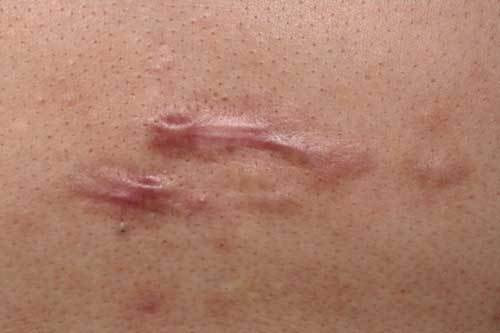 ケロイド 11回施術後