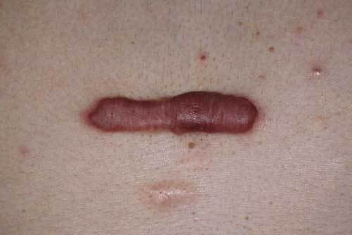 ケロイド 治療前