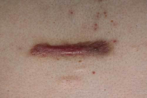 ケロイド 8回施術後