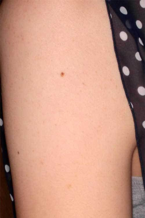 ダーマペンによる毛孔性苔癬の治療2回後