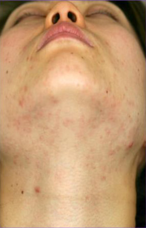 AGNES3回治療後2ヶ月