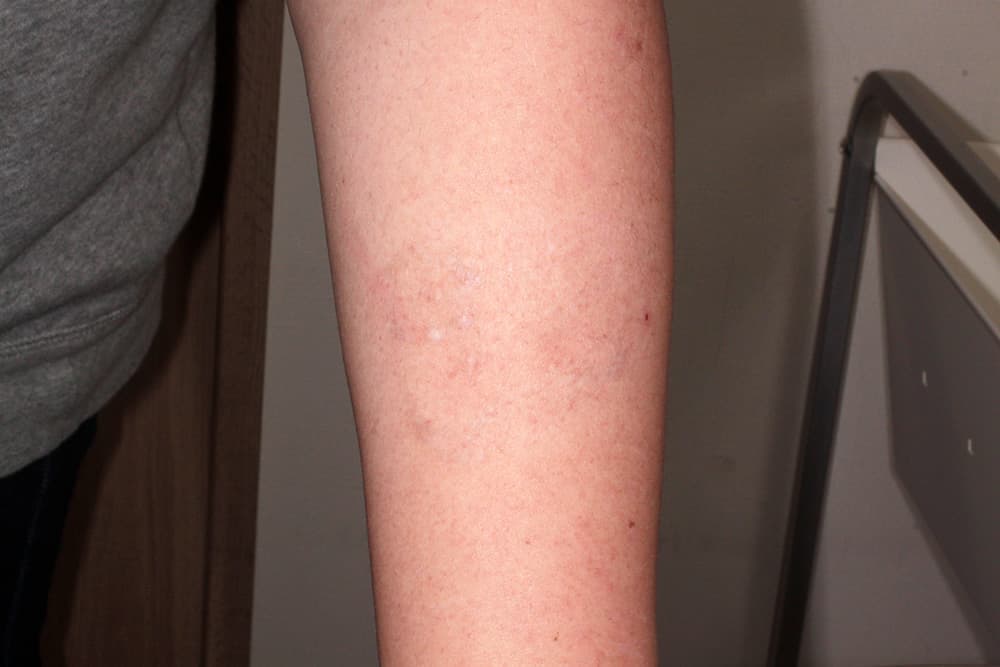 治療後約5年経過