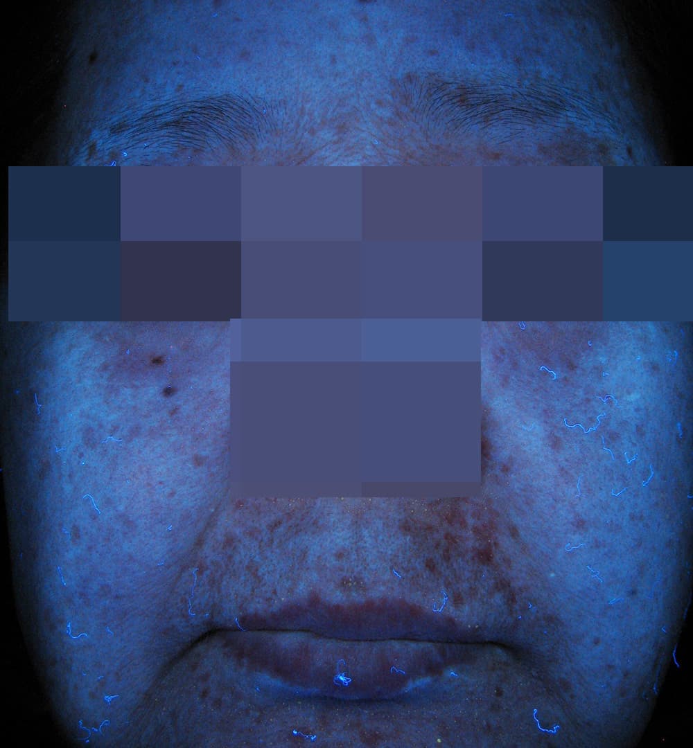 治療後2ヶ月の老人性色素斑