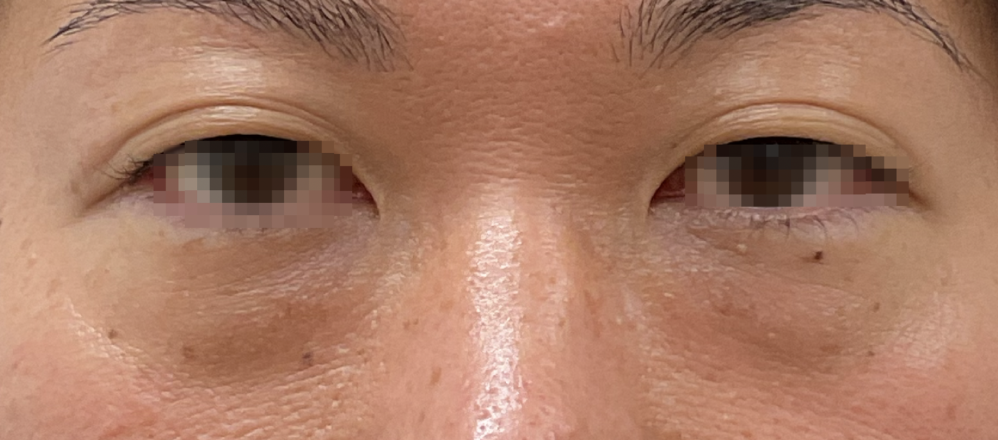 PRPゴルゴライン治療前正面