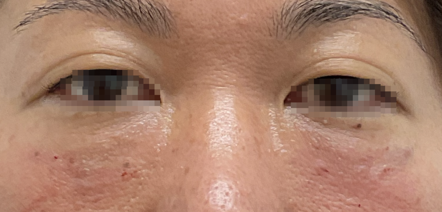 PRPゴルゴライン治療前横顔