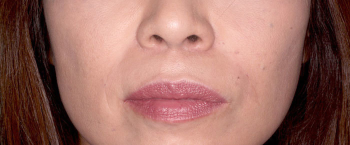 ほうれい線 治療直後