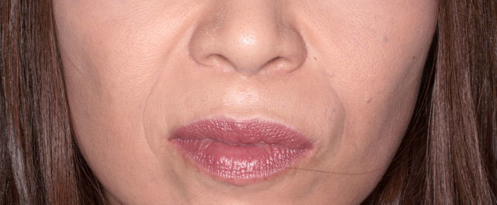 ほうれい線 治療前