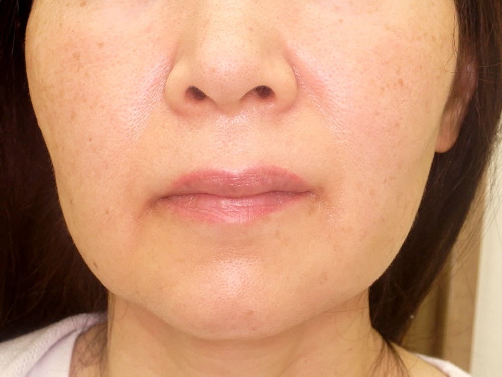 治療前・両頬で6本使用しています。