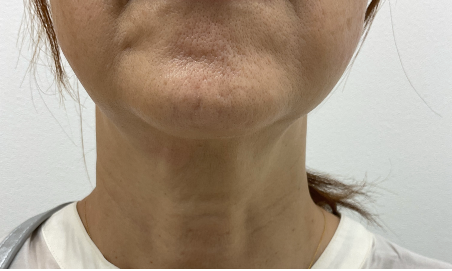 PRP首のシワ治療後左側