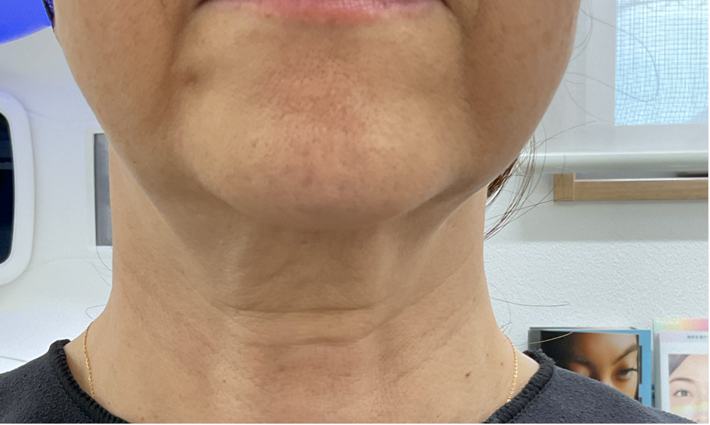 PRP首のシワ治療前左側