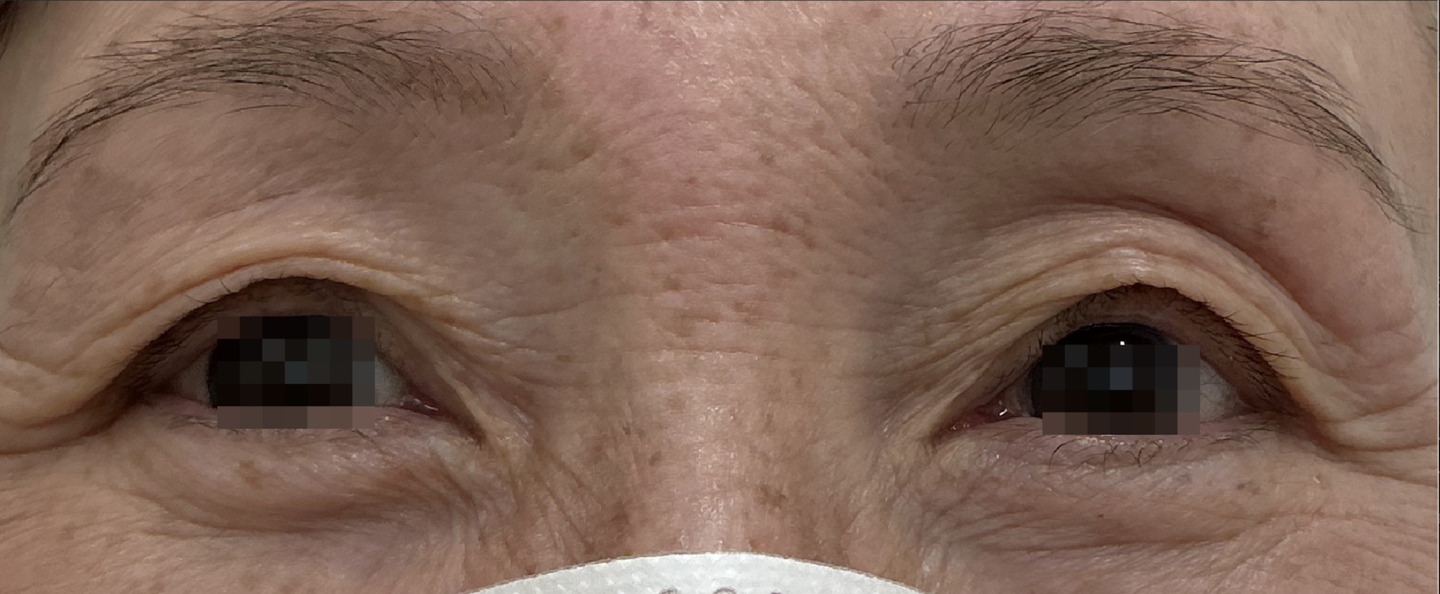 切らない眼瞼下垂施術後