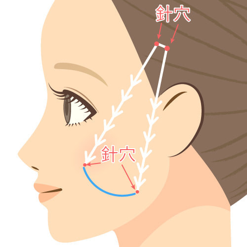 アンカーDXダブルの施術イメージ
