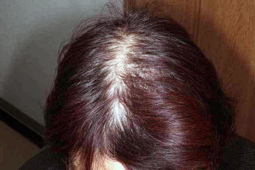 ミノキシジルアルファローション外用使用3ヶ月後