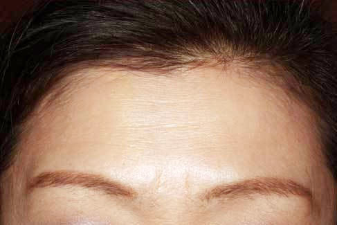 額(静止時)治療後