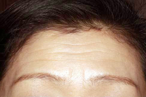 額(静止時)治療前