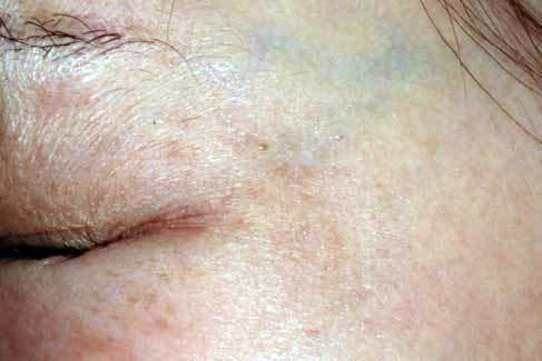 目尻(収縮時)治療後