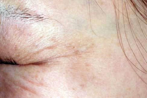 目尻(収縮時)治療前