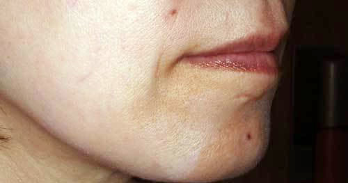 治療前 両頬で6本使用しています。