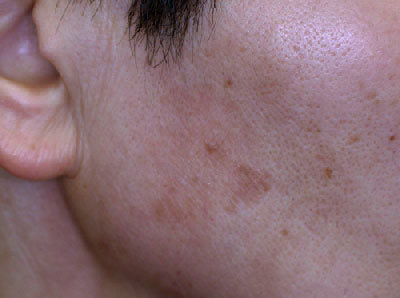 治療後2ヶ月の老人性色素斑