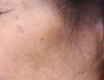 治療後1ヶ月の老人性色素斑