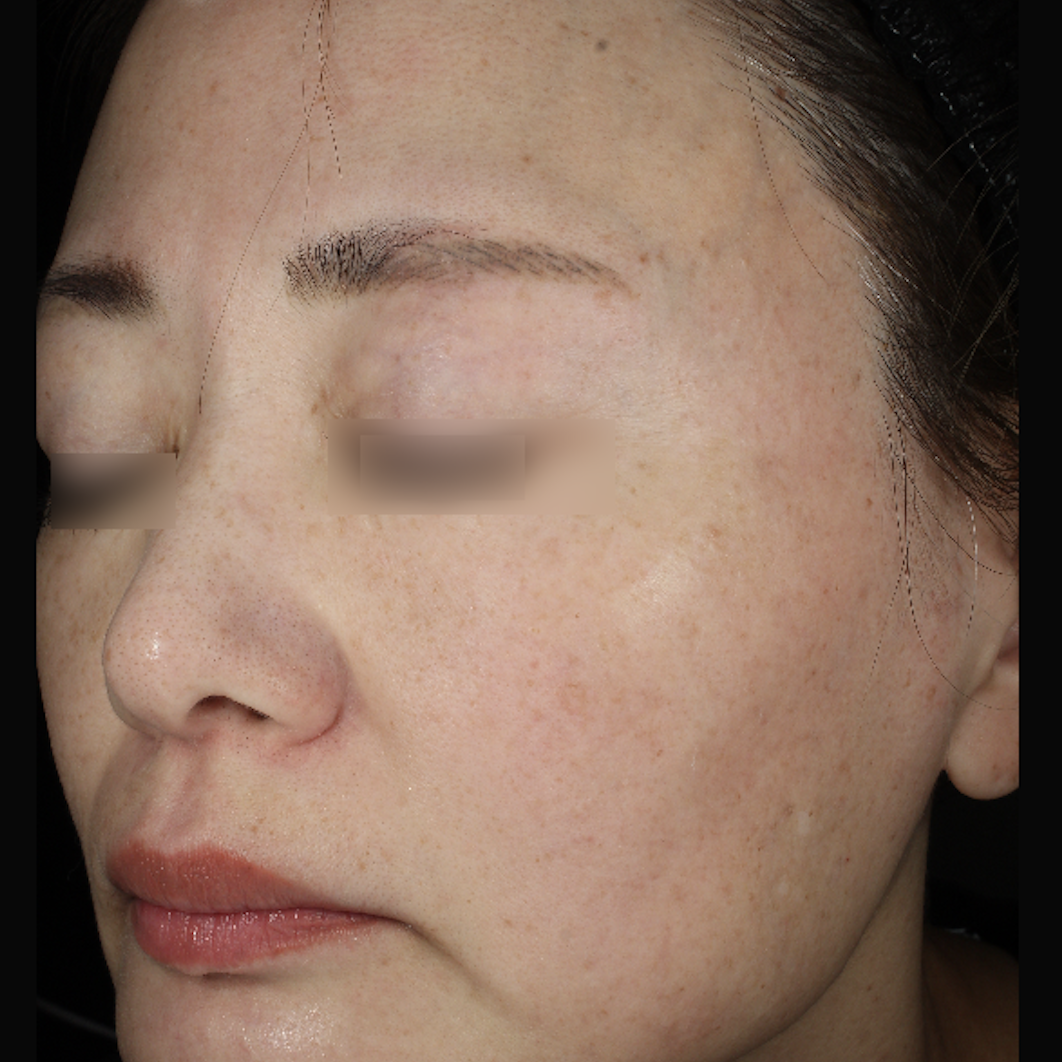 ピコトーニング4回治療後