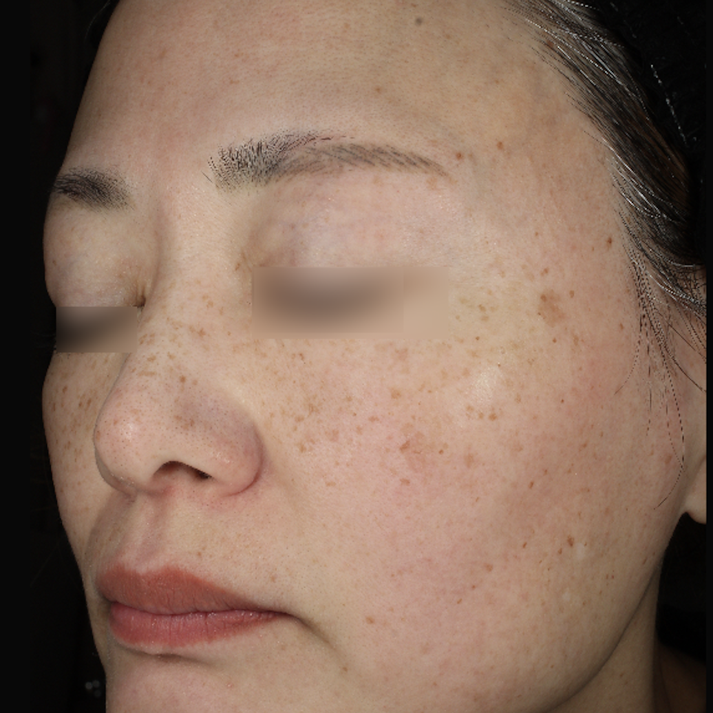 ピコトーニング治療前