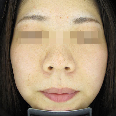 ピコトーニング4回治療後