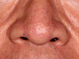 毛細血管拡張症(酒さ)の治療後