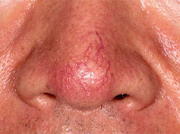 毛細血管拡張症(酒さ)の治療前