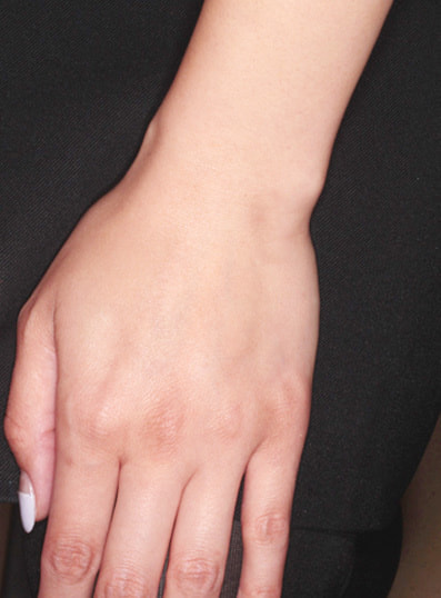 ハンドベイン治療後(左手)