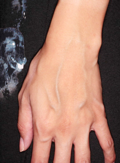 ハンドベイン治療開始前(左手)