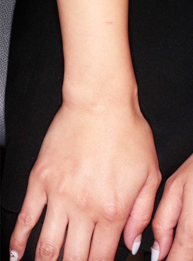 ハンドベイン治療後(右手)