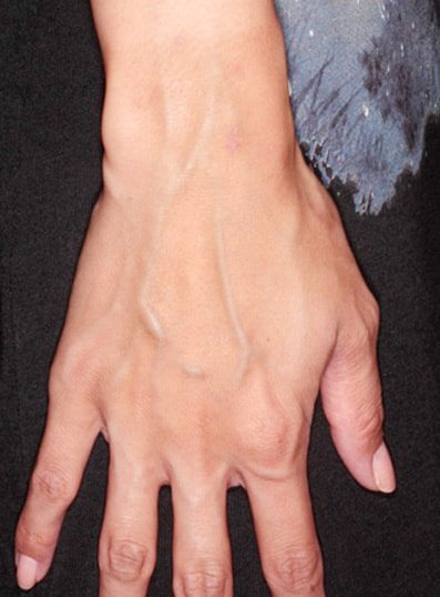 ハンドベイン治療開始前(右手)