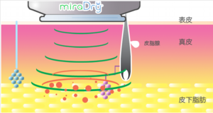 ミラドライの仕組み