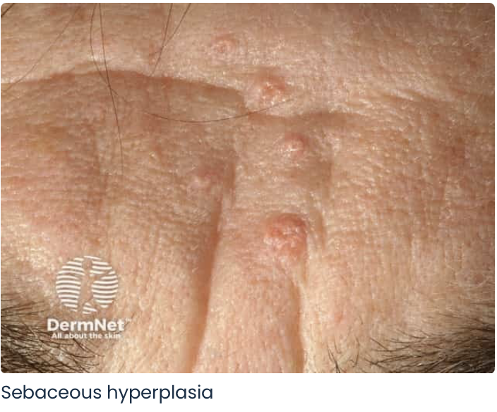 老人性脂腺増殖症の画像